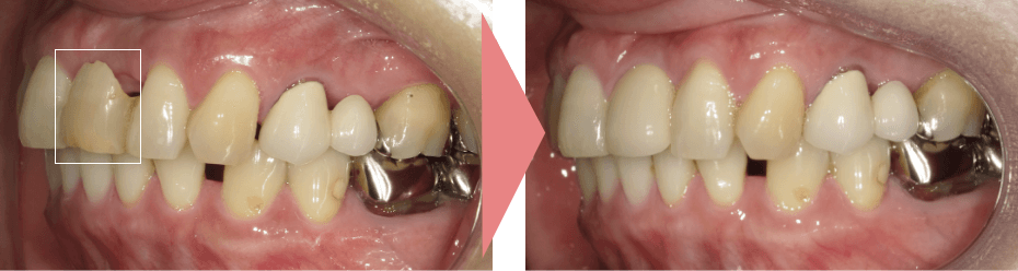 症例A：インプラント治療