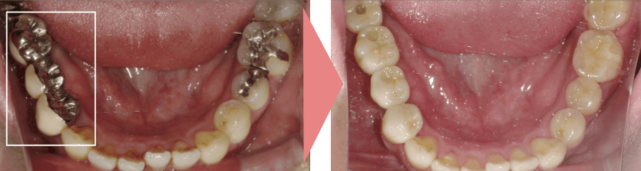 症例B：インプラント治療