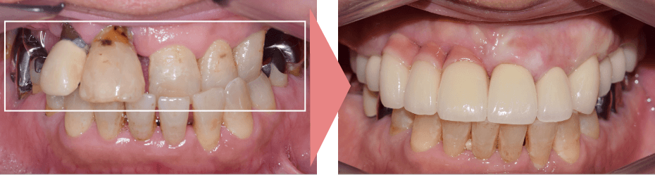 症例C：インプラント治療