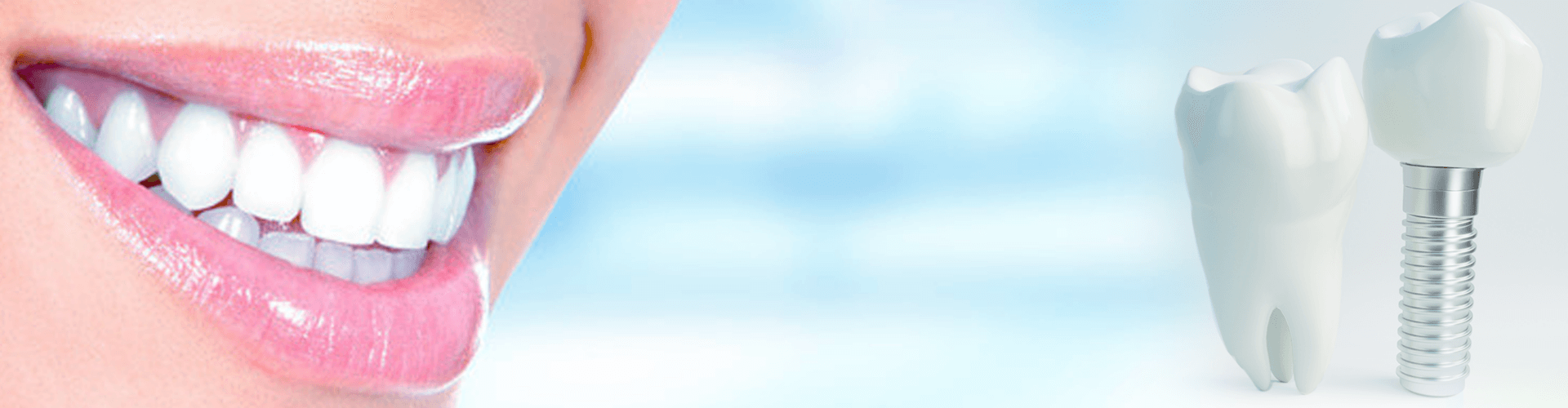 歯列矯正の種類