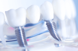 虫歯になりにくく、劣化もしにくいので長期的に使用可能