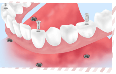 All-on-4（オールオンフォー）