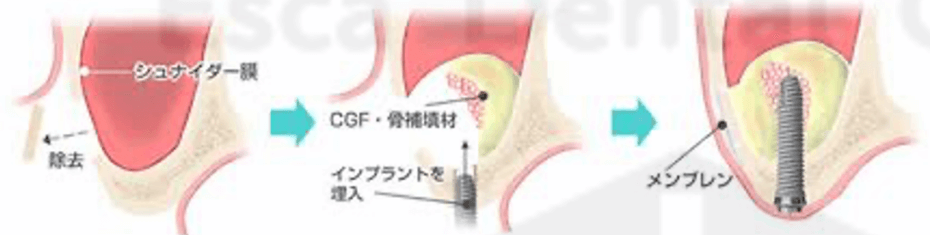 サイナスリフト