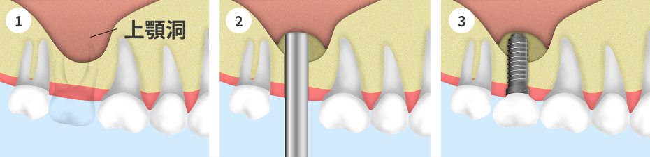 ソケットリフト