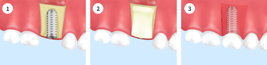 GBR（骨再生誘導療法）