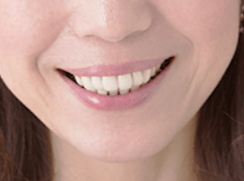 クリアライン矯正をした患者様の声